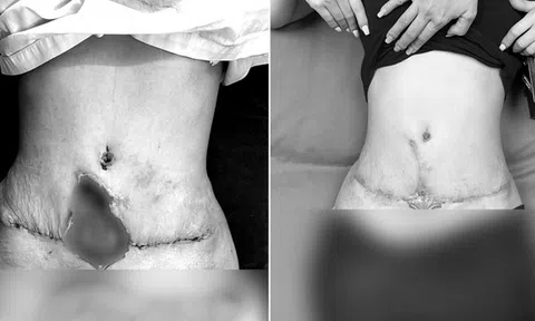 Hút mỡ bụng "hỏng", nữ bệnh nhân bị hoại tử với vết thủng 10cm giữa bụng