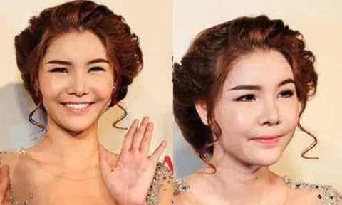 Người mẫu Kỳ Hân - vợ Mạc Hồng Quân - khủng hoảng vì khuôn mặt biến dạng do phẫu thuật thẩm mỹ